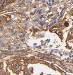 Immunohistochemistry: NOMO2 Antibody - BSA Free [NBP3-47323] - Immunohistochemistry of paraffin-embedded human pancreas cancer using (NOMO2 antibody) at dilution of 1:100