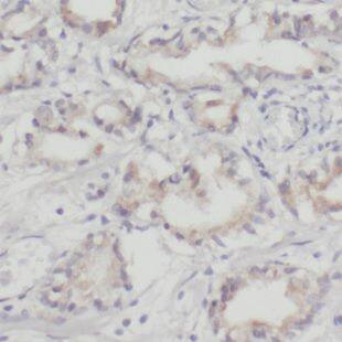 Immunohistochemistry: NHP2 Antibody - BSA Free [NBP3-47342] - Immunohistochemistry of paraffin-embedded human prostate cancer using (NHP2 antibody) at dilution of 1:100