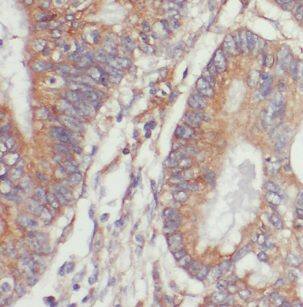 Immunohistochemistry: NET1 Antibody - BSA Free [NBP3-47356] - Immunohistochemistry of paraffin-embedded human rectal cancer using (NET1 Antibody) at dilution of 1:50