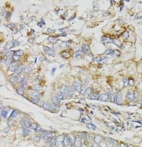 Immunohistochemistry: NDUFS7 Antibody - BSA Free [NBP3-47364] - Immunohistochemistry of paraffin-embedded human gastric cancer using (NDUFS7 antibody) at dilution of 1:100