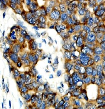 Immunohistochemistry: PGAM5 Antibody - BSA Free [NBP3-47421] - Immunohistochemistry of paraffin-embedded human breast cancer using (PGAM5 antibody) at dilution of 1:50