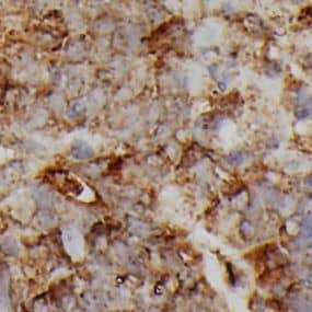 Immunohistochemistry: MED14 Antibody - BSA Free [NBP3-47470] - Immunohistochemistry of paraffin-embedded human colon cancer using (MED14 antibody) at dilution of 1:200