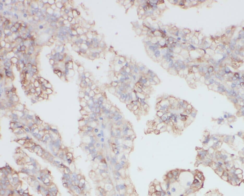 Immunohistochemistry: NY-REN-50 antigen Antibody - BSA Free [NBP3-47502] - Immunohistochemistry of paraffin-embedded human renal cell carcinoma using (NY-REN-50 antigen antibody) at dilution of 1:50