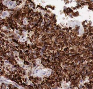 Immunohistochemistry: COX7A1 Antibody - BSA Free [NBP3-47537] - Immunohistochemistry of paraffin-embedded human gliomas using (COX7A1 antibody) at dilution of 1:100