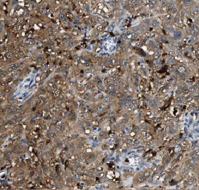 Immunohistochemistry: Coronin 3 Antibody - BSA Free [NBP3-47547] - Immunohistochemistry of paraffin-embedded human cervical cancer using (Coronin 3 antibody) at dilution of 1:100