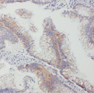 Immunohistochemistry: Connexin 26/GJB2 Antibody - BSA Free [NBP3-47559] - Immunohistochemistry of paraffin-embedded human colon cancer using (Connexin 26/GJB2 antibody) at dilution of 1:50