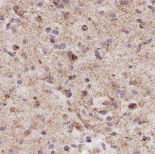 Immunohistochemistry: Carbohydrate Sulfotransferase 10/CHST10 Antibody - BSA Free [NBP3-47611] - Immunohistochemistry of paraffin-embedded human gliomas using (Carbohydrate Sulfotransferase 10/CHST10 antibody) at dilution of 1:50