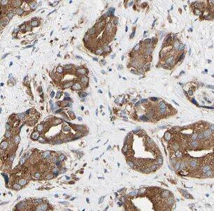 Immunohistochemistry: Nicotinic Acetylcholine R alpha 3/CHRNA3 Antibody - BSA Free [NBP3-47616] - Immunohistochemistry of paraffin-embedded human prostate cancer using (Nicotinic Acetylcholine R alpha 3/CHRNA3 antibody) at dilution of 1:50