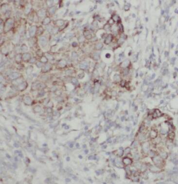 Immunohistochemistry: Choline kinase alpha Antibody - BSA Free [NBP3-47620] - Immunohistochemistry of paraffin-embedded human breast cancer tissue slide using (Choline kinase alpha antibody) at dilution of 1:50
