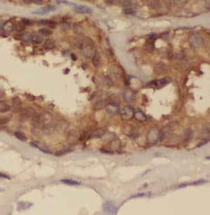 Immunohistochemistry: CEP97 Antibody - BSA Free [NBP3-47638] - Immunohistochemistry of paraffin-embedded human breast cancer using (CEP97 antibody) at dilution of 1:50
