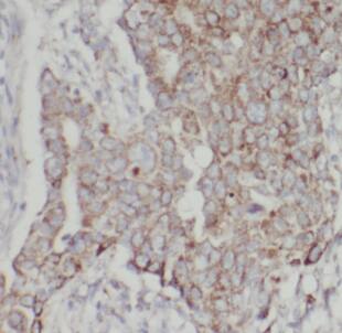 Immunohistochemistry: Cadherin-26 Antibody - BSA Free [NBP3-47657] - Immunohistochemistry of paraffin-embedded human breast cancer tissue slide using (Cadherin-26 Antibody) at dilution of 1:50