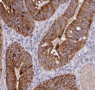 Immunohistochemistry: CDC42SE2 Antibody - BSA Free [NBP3-47663] - Immunohistochemistry of paraffin-embedded human colon cancer tissue slide using (CDC42SE2 Antibody) at dilution of 1:50