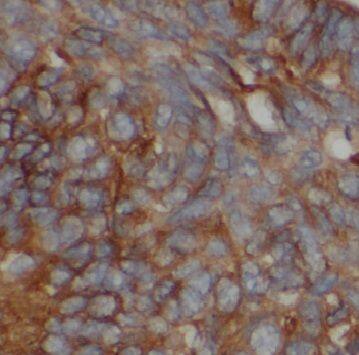Immunohistochemistry: CPR8 Antibody - BSA Free [NBP3-47673] - Immunohistochemistry of paraffin-embedded human liver cancer using (CPR8 antibody) at dilution of 1:50