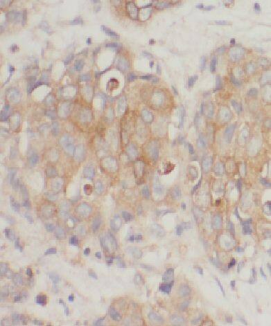 Immunohistochemistry: CCDC99 Antibody - BSA Free [NBP3-47678] - Immunohistochemistry of paraffin-embedded human breast cancer slide using (CCDC99 Antibody) at dilution of 1:50