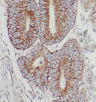 Immunohistochemistry: TMEM74B Antibody - BSA Free [NBP3-47770] - Immunohistochemistry of paraffin-embedded human colon cancer tissue slide using ( TMEM74B Antibody) at dilution of 1:50