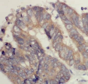 Immunohistochemistry: Mic1 Antibody - BSA Free [NBP3-47801] - Immunohistochemistry of paraffin-embedded human colon cancer using (Mic1 antibody) at dilution of 1:100