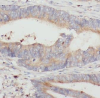 Immunohistochemistry: C18orf21 Antibody - BSA Free [NBP3-47804] - Immunohistochemistry of paraffin-embedded human colon cancer tissue slide using (C18orf21 Antibody) at dilution of 1:50