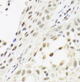 Immunohistochemistry: CLE7 homolog Antibody - BSA Free [NBP3-47822] - Immunohistochemistry of paraffin-embedded human lung cancer using (CLE7 homolog antibody) at dilution of 1:100