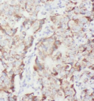 Immunohistochemistry: MZT1 Antibody - BSA Free [NBP3-47826] - Immunohistochemistry of paraffin-embedded human breast cancer tissue slide using ( MZT1 Antibody) at dilution of 1:50
