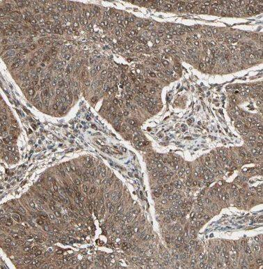 Immunohistochemistry: CCDC7 Antibody - BSA Free [NBP3-47838] - Immunohistochemistry of paraffin-embedded human cervical cancer tissue slide using (CCDC7 Antibody) at dilution of 1:50