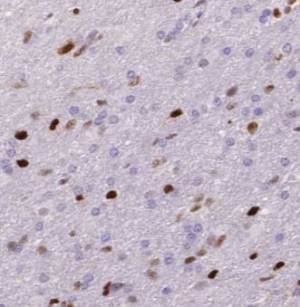 Immunohistochemistry: BRUNOL5 Antibody - BSA Free [NBP3-47850] - Immunohistochemistry of paraffin-embedded human gliomas using (BRUNOL5 antibody) at dilution of 1:50