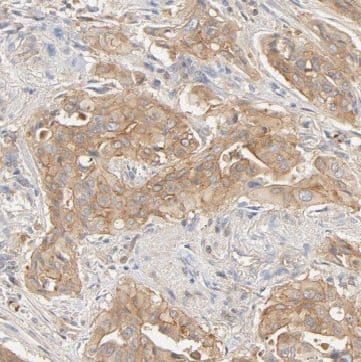 Immunohistochemistry: Begain Antibody - BSA Free [NBP3-47865] - Immunohistochemistry of paraffin-embedded human pancreas cancer using (Begain antibody) at dilution of 1:50
