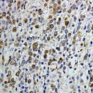 Immunohistochemistry: Bcl3 Antibody - BSA Free [NBP3-47870] - Immunohistochemistry of paraffin-embedded human lymphoma tissue slide using (Bcl3 Antibody) at dilution of 1:50