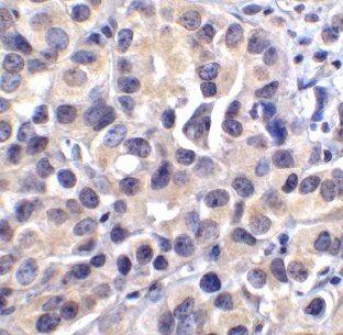 Immunohistochemistry: BCAT1 Antibody - BSA Free [NBP3-47874] - Immunohistochemistry of paraffin-embedded human lymphoma tissue slide using (BCAT1 Antibody) at dilution of 1:50