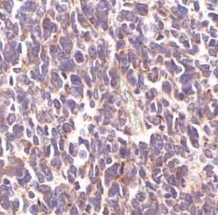 Immunohistochemistry: SMARCC2/BAF170 Antibody - BSA Free [NBP3-47888] - Immunohistochemistry of paraffin-embedded human medulloblastoma using (SMARCC2/BAF170 antibody) at dilution of 1:50