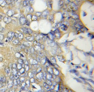 Immunohistochemistry: ATPAF2 Antibody - BSA Free [NBP3-47910] - Immunohistochemistry of paraffin-embedded human colon cancer using (ATPAF2 antibody) at dilution of 1:50