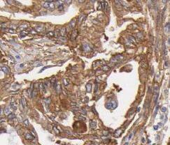 Immunohistochemistry: ATG2B Antibody - BSA Free [NBP3-47929] - Immunohistochemistry of paraffin-embedded human pancreas cancer tissue slide using (ATG2B Antibody) at dilution of 1:50