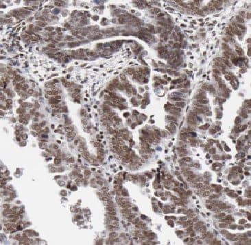 Immunohistochemistry: ARL2 Antibody - BSA Free [NBP3-47962] - Immunohistochemistry of paraffin-embedded human ovary tumor using (ARL2 antibody) at dilution of 1:100