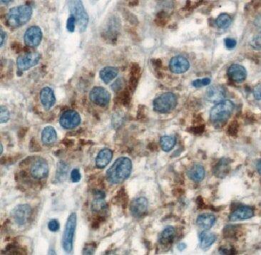 Immunohistochemistry: ARL15 Antibody - BSA Free [NBP3-47963] - Immunohistochemistry of paraffin-embedded human lymphoma using (ARL15 antibody) at dilution of 1:50