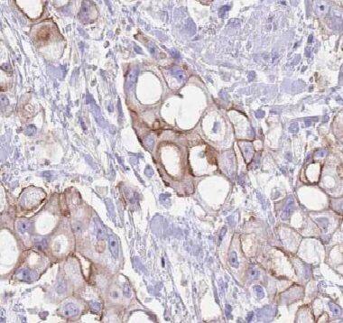 Immunohistochemistry: p114RhoGEF Antibody - BSA Free [NBP3-47967] - Immunohistochemistry of paraffin-embedded human pancreas cancer using (p114RhoGEF antibody) at dilution of 1:50