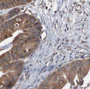 Immunohistochemistry: DOCK4 Antibody - BSA Free [NBP3-47972] - Immunohistochemistry of paraffin-embedded human ovary tumor tissue slide using ( DOCK4 Antibody) at dilution of 1:200