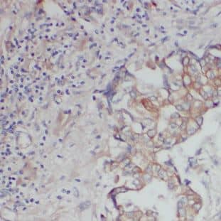 Immunohistochemistry: DNAJC4 Antibody - BSA Free [NBP3-47983] - Immunohistochemistry of paraffin-embedded human breast cancer using (DNAJC4 antibody) at dilution of 1:100