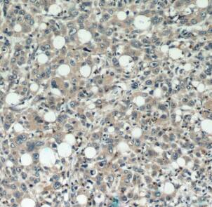 Immunohistochemistry: DEFB121 Antibody - BSA Free [NBP3-48026] - Immunohistochemistry of paraffin-embedded human stomach cancer using (DEFB121 antibody) at dilution of 1:100