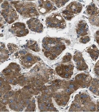 Immunohistochemistry: D2HGDH Antibody - BSA Free [NBP3-48052] - Immunohistochemistry of paraffin-embedded human liver cancer using (D2HGDH antibody) at dilution of 1:50