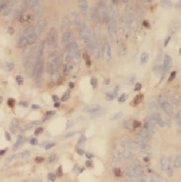 Immunohistochemistry: CYP4F12 Antibody - BSA Free [NBP3-48060] - Immunohistochemistry of paraffin-embedded human colon cancer using (CYP4F12 antibody) at dilution of 1:100