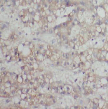 Immunohistochemistry: Cytochrome p450 2J2 Antibody - BSA Free [NBP3-48064] - Immunohistochemistry of paraffin-embedded human liver cancer using (Cytochrome p450 2J2 antibody) at dilution of 1:50