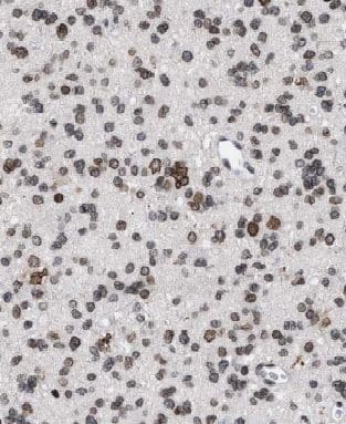 Immunohistochemistry: CYFIP2 Antibody - BSA Free [NBP3-48069] - Immunohistochemistry of paraffin-embedded human gliomas using (CYFIP2 antibody) at dilution of 1:50