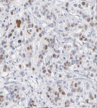 Immunohistochemistry: Cyclin G Antibody - BSA Free [NBP3-48072] - Immunohistochemistry of paraffin-embedded human breast cancer using (Cyclin G antibody) at dilution of 1:100