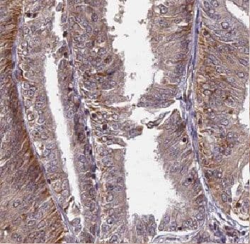 Immunohistochemistry: CUTC Antibody - BSA Free [NBP3-48084] - Immunohistochemistry of paraffin-embedded human endometrial cancer using (CUTC antibody) at dilution of 1:100