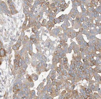 Immunohistochemistry: CTDSPL2 Antibody - BSA Free [NBP3-48088] - Immunohistochemistry of paraffin-embedded human endometrial cancer using (CTDSPL2 antibody) at dilution of 1:100