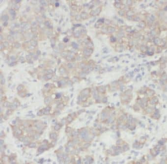 Immunohistochemistry: CSN3 Antibody - BSA Free [NBP3-48098] - Immunohistochemistry of paraffin-embedded human breast cancer using (CSN3 antibody) at dilution of 1:50