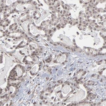 Immunohistochemistry: CROP Antibody - BSA Free [NBP3-48107] - Immunohistochemistry of paraffin-embedded human pancreas cancer using (CROP antibody) at dilution of 1:50