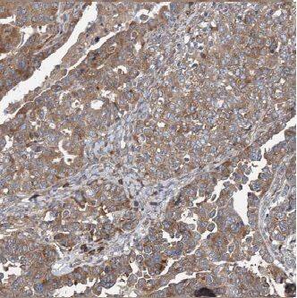 Immunohistochemistry: AP3S2 Antibody - BSA Free [NBP3-48132] - Immunohistochemistry of paraffin-embedded human ovary tumor using (AP3S2 antibody) at dilution of 1:100