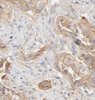 Immunohistochemistry: Pancreatic Amylase Beta Antibody - BSA Free [NBP3-48166] - Immunohistochemistry of paraffin-embedded human pancreas cancer using (Pancreatic Amylase Beta antibody) at dilution of 1:50