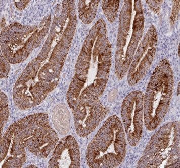 Immunohistochemistry: AMN1 Antibody - BSA Free [NBP3-48171] - Immunohistochemistry of paraffin-embedded human colon cancer using (AMN1 antibody) at dilution of 1:100