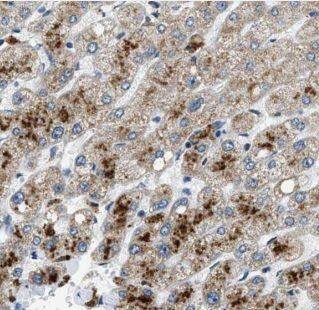 Immunohistochemistry: ALPK1 Antibody - BSA Free [NBP3-48176] - Immunohistochemistry of paraffin-embedded human hepatocirrhosis using (ALPK1 antibody) at dilution of 1:50